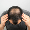 Comprendre et Stopper la Chute des Cheveux
